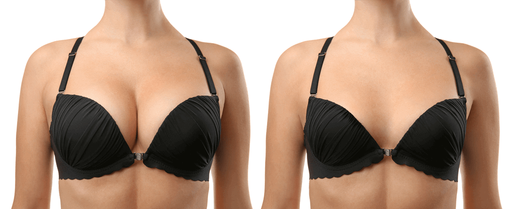 Breast Augmentation Guide: Natural Results at Nypunya Clinic