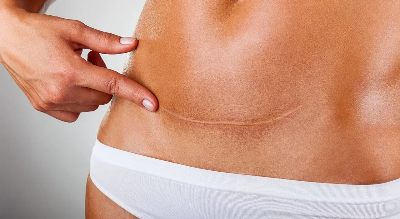Tummy Tuck Surgery in Bangalore: Comprehensive Guide to Abdominoplasty at Nypunya Aesthetics