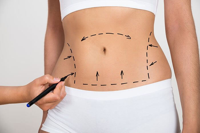 Liposuction for Indian Bodies: Tailored Fat Removal Guide in Bangalore 2026